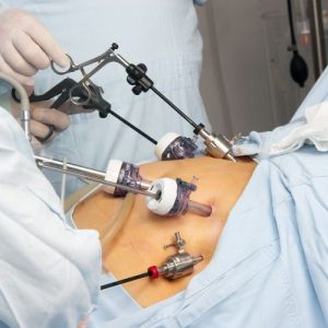 Is Laparoscopic Surgery the Best Option for Me